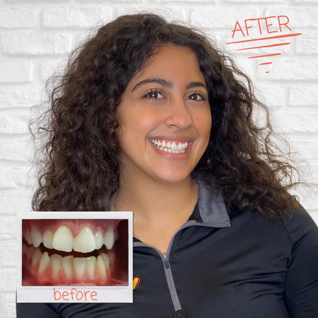 Before and After patient pics from Mint-Orthodontics Edina MN
